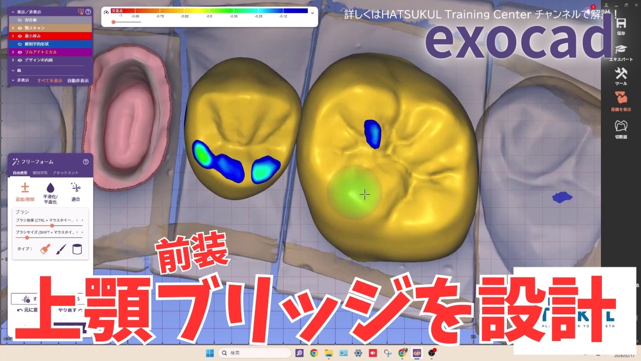 #342　exocad設計　上顎（前装）ブリッジを設計（解説なし版）