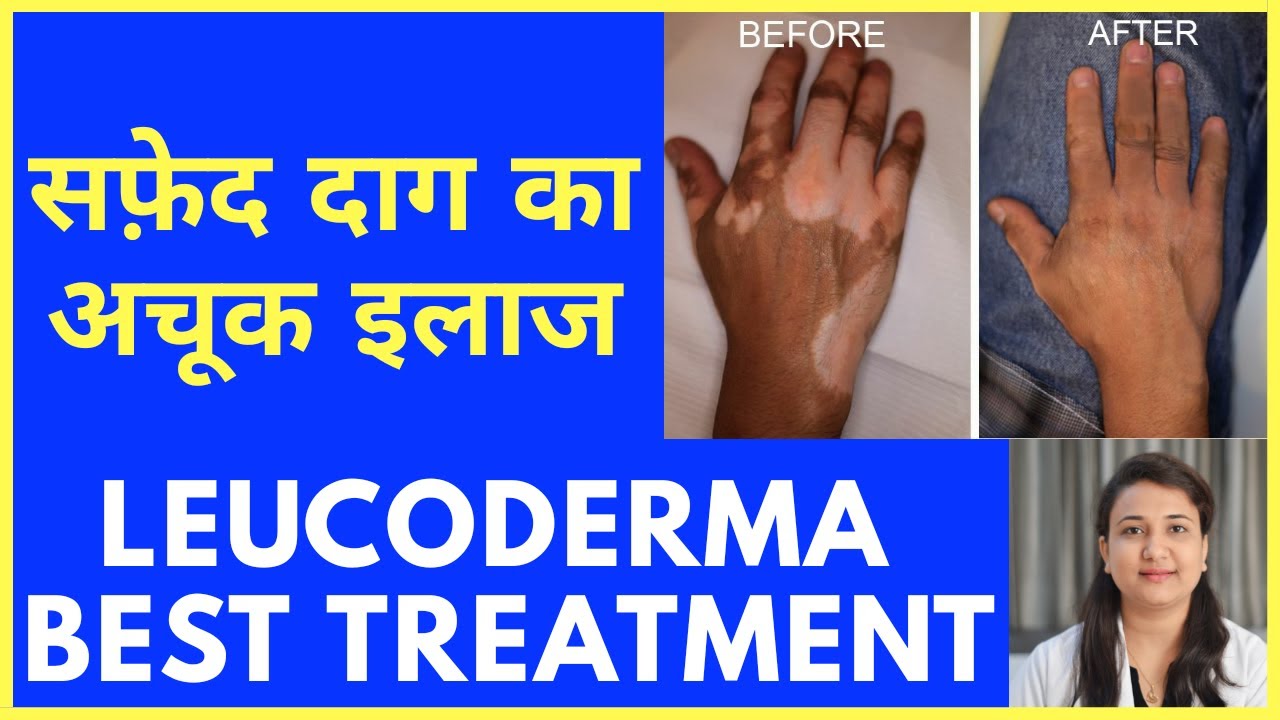 सफ़ेद दाग का अचूक इलाज | LEUCODERMA BEST TREATMENT
