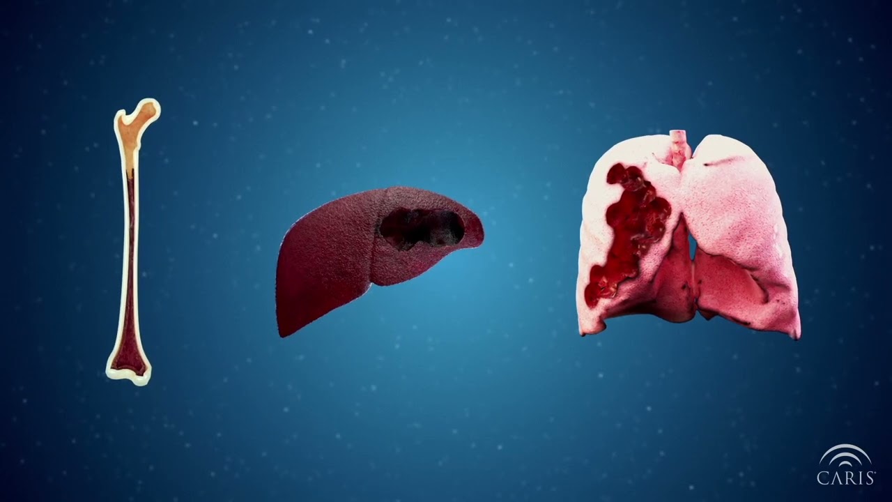 Difference between Primary and Metastatic Cancer | Central Principles of Molecular Biology
