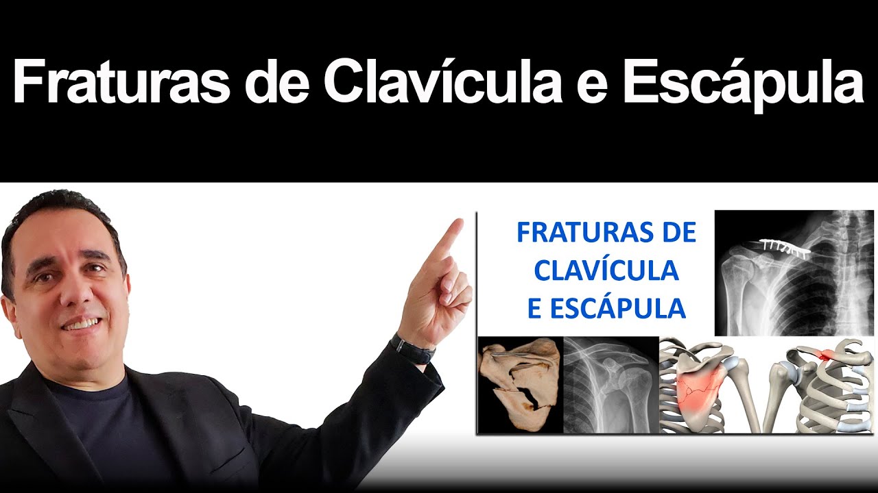 Fraturas de Clavícula e Escápula