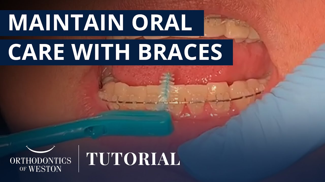 How to Maintain Oral Care While Wearing Braces | Orthodontics of Weston