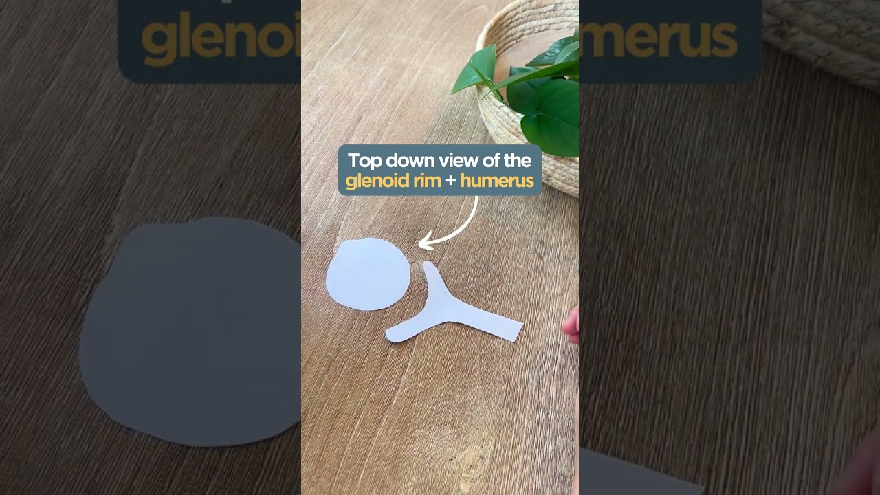 Hill Sachs Fractures