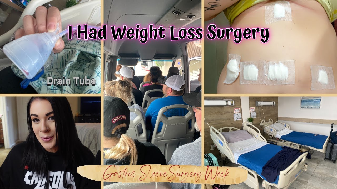 Weight Loss Surgery | Elias Ortiz & Company | VSG | Gastric Sleeve