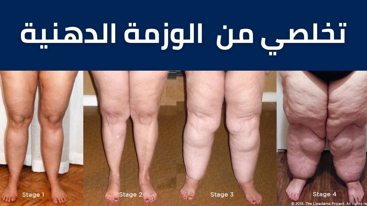 الليبيديما (الوزمة الدهنية)… الأسباب وطرق العلاج