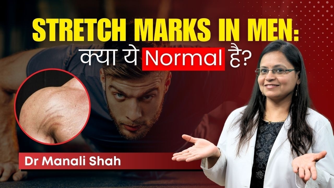 Why do men get stretch marks? | Clear Skin Pune - Dr. Manali Shah