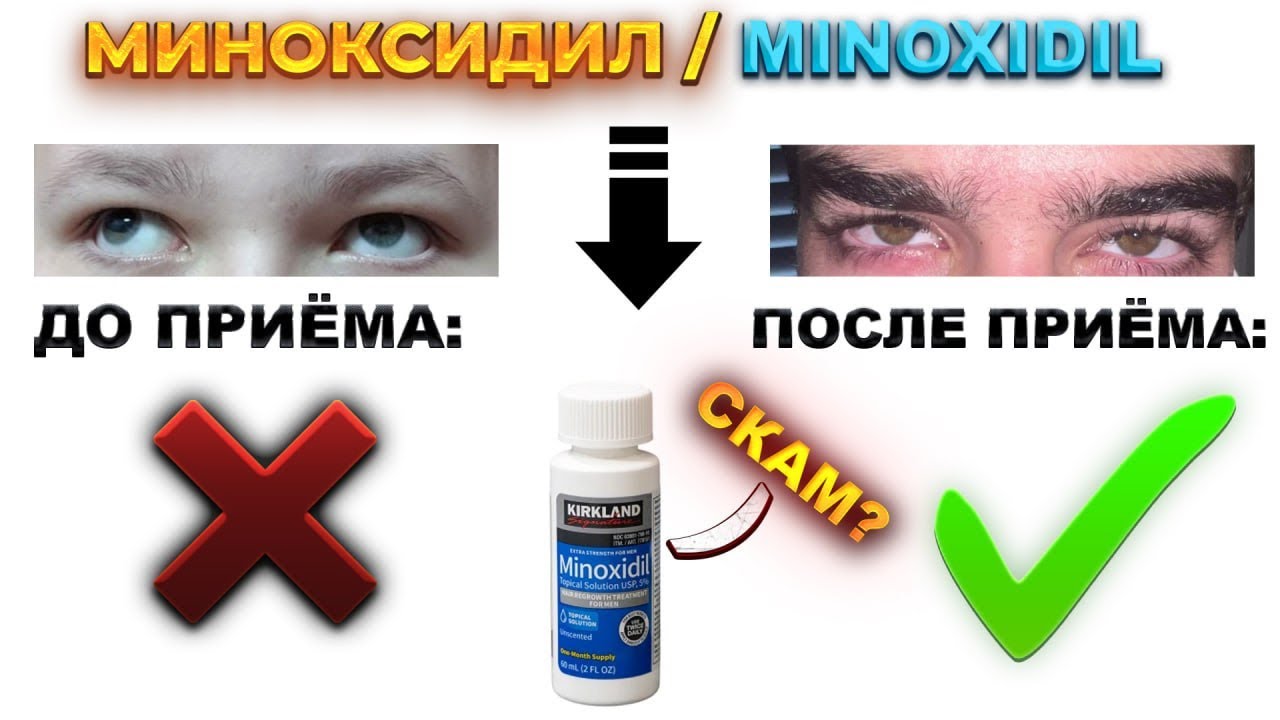 Как миноксидил изменил мою жизнь, мой опыт + советы