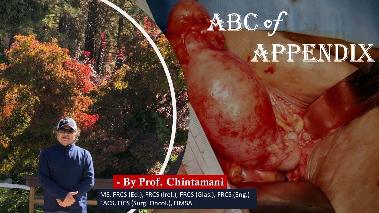 ABC of Appendix by Prof. Chintamani