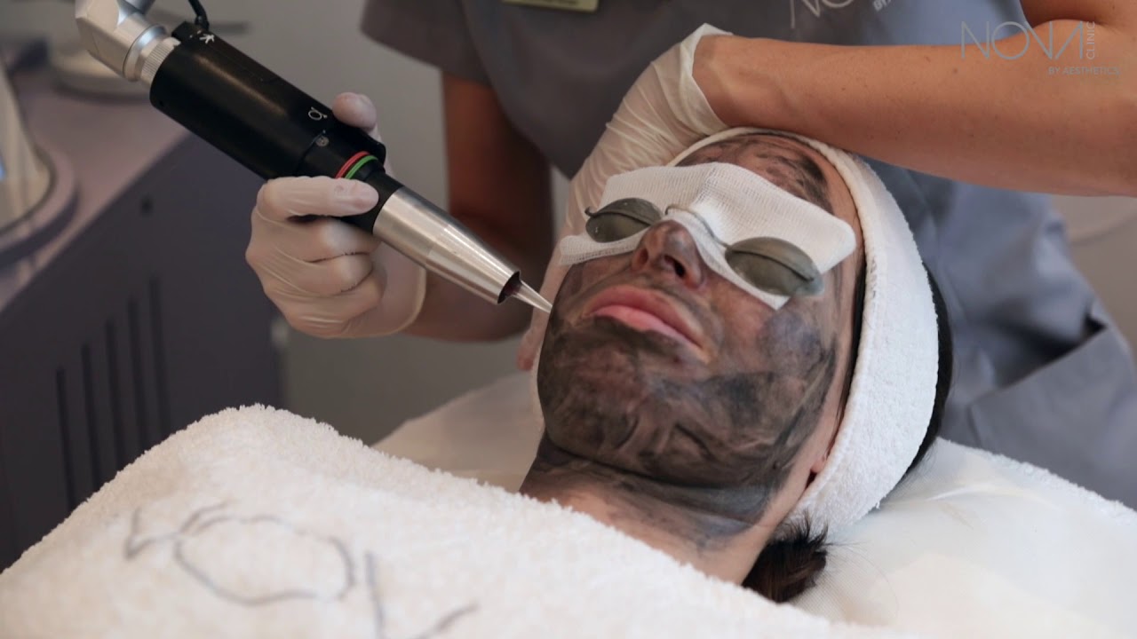 Hollywood Facial (Carbon Peel)