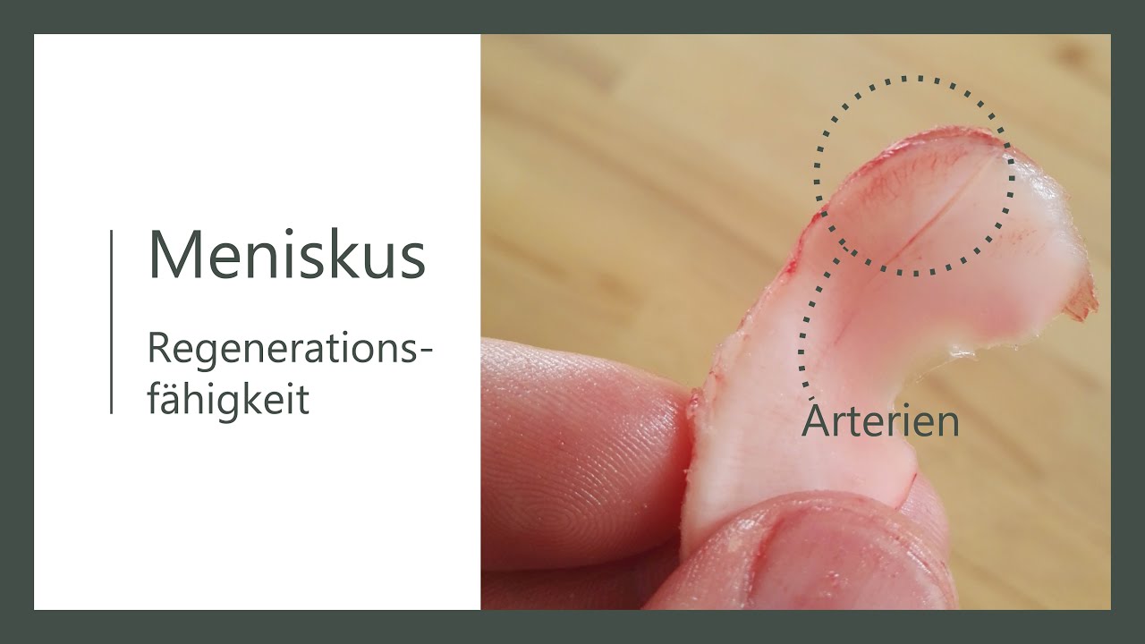 Meniskus - Verletzung - kann er regenerieren? Blutversorgung und Gelenkflüssigkeit
