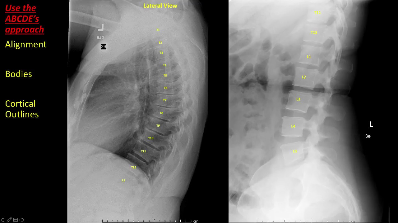 Introduction to Spine Radiographs