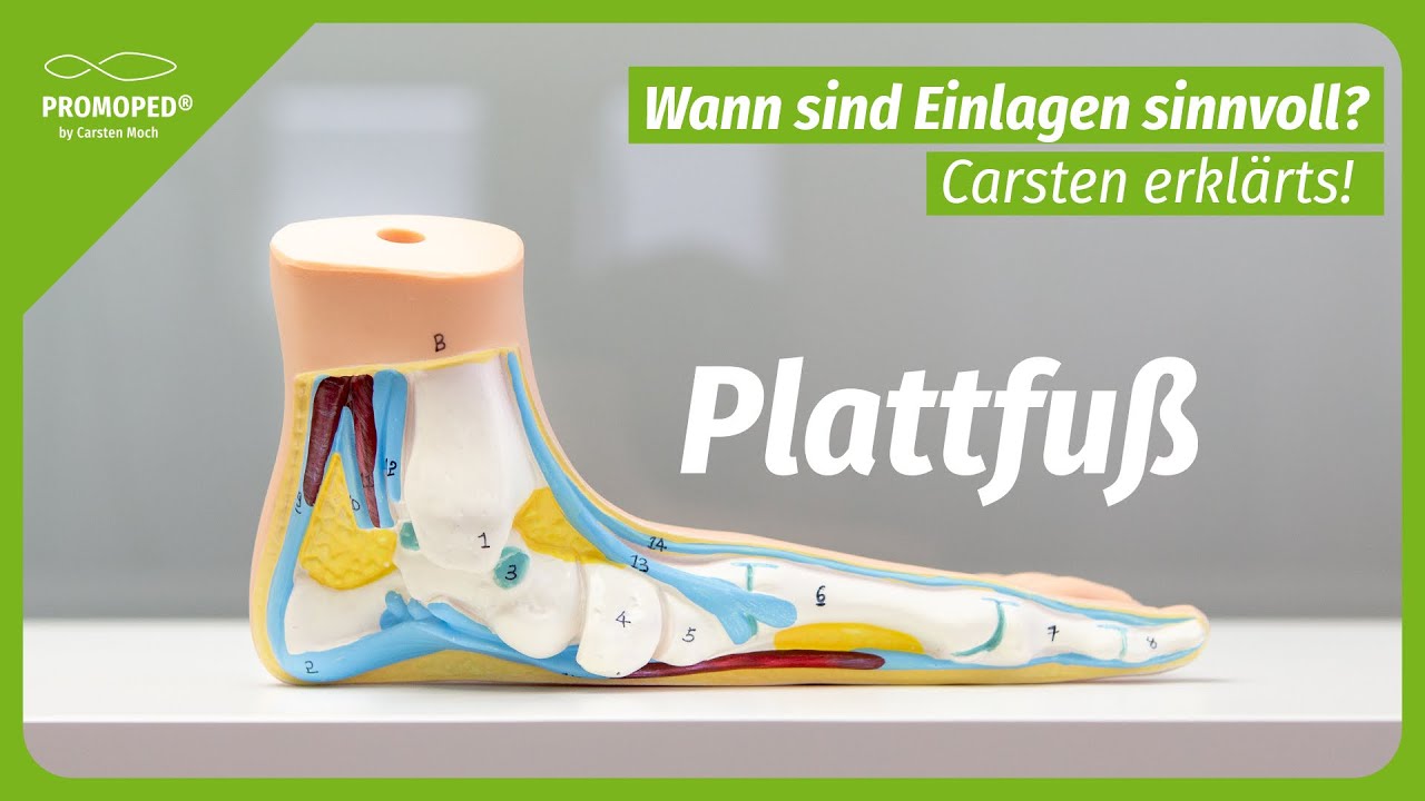 Plattfuß erklärt: Alles, was Du wissen musst!