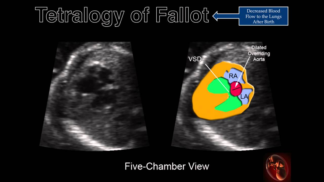 Fetal Echocardiography: Tetralogy of Fallot