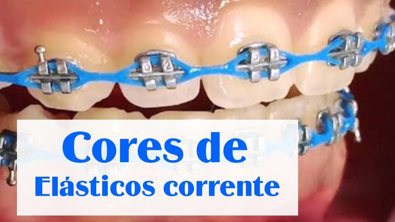 Cores de elástico corrente em aparelhos