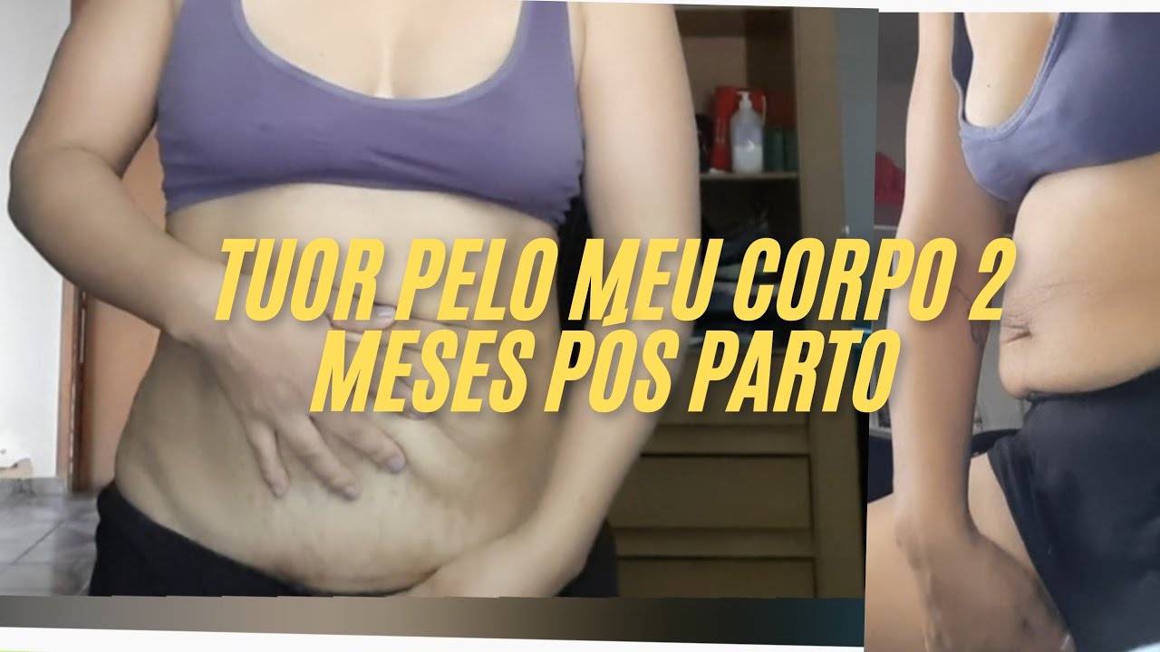 Tive muita flacidez barriga bem mole segunda gestação