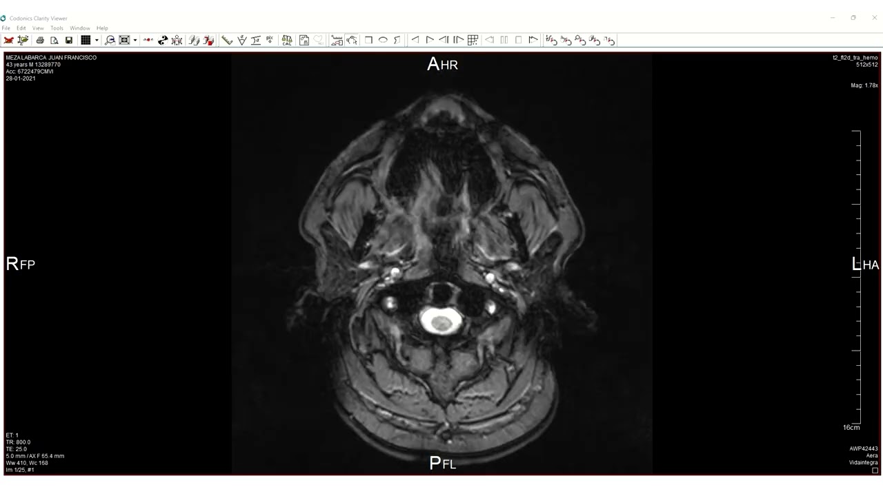 RESONANCIA DAÑO CEREBRAL JUAN MEZA LABARCA