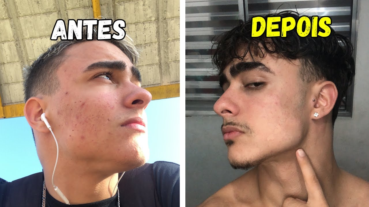 Como ACABAR com as suas ESPINHAS sem sair de casa!