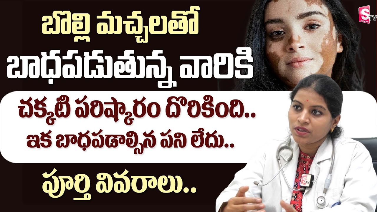 బొల్లి మచ్చలకు పరిష్కారం | Bolli Machalu Treatment in Telugu | Dr Archana | @SumanTV
