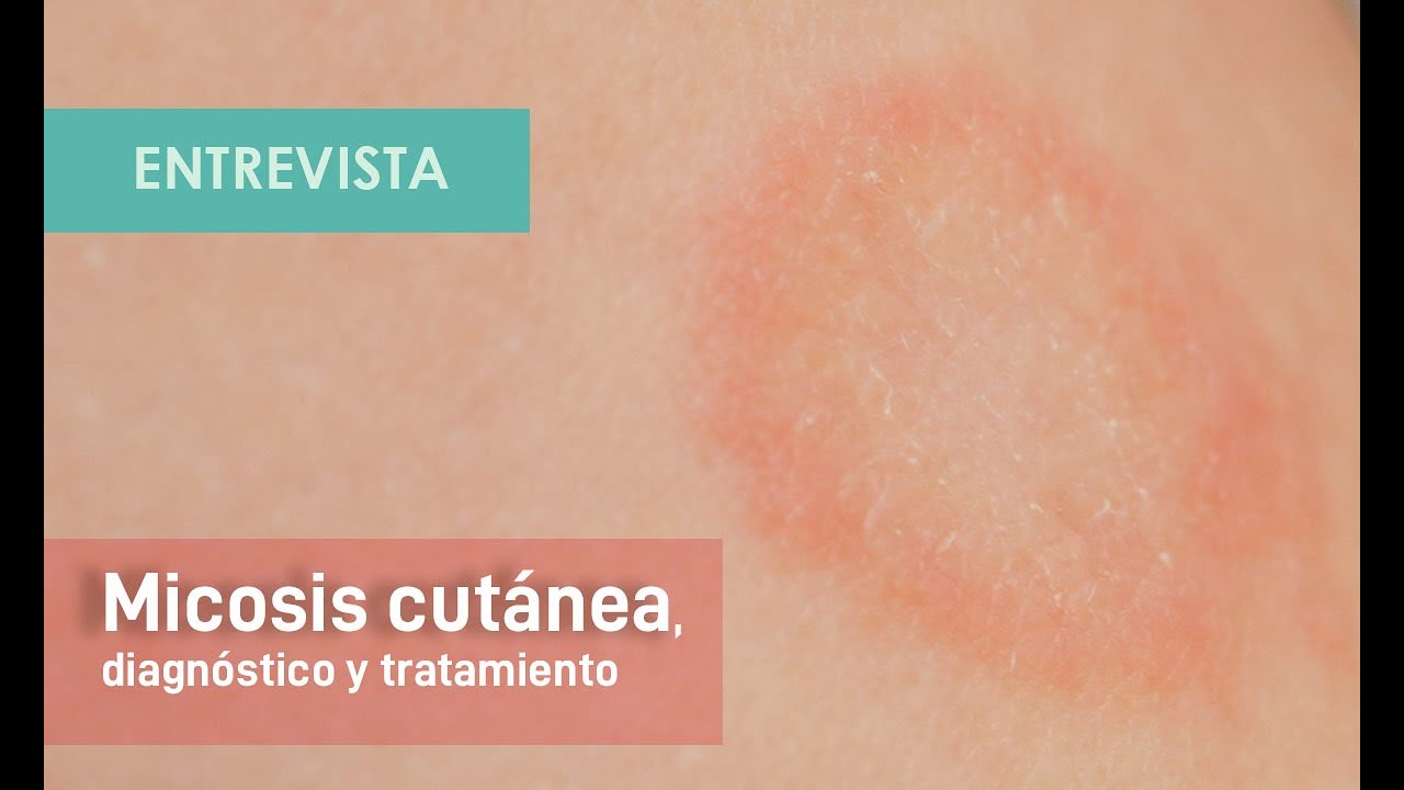 Diagnóstico y tratamiento de las micosis cutáneas.