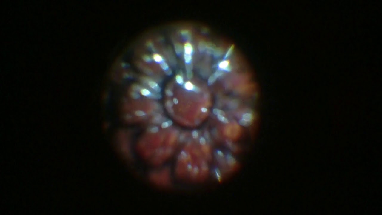 Optic disc pit maculopathy: tamponade of maculoschisis - Video abstract [ID 212421]