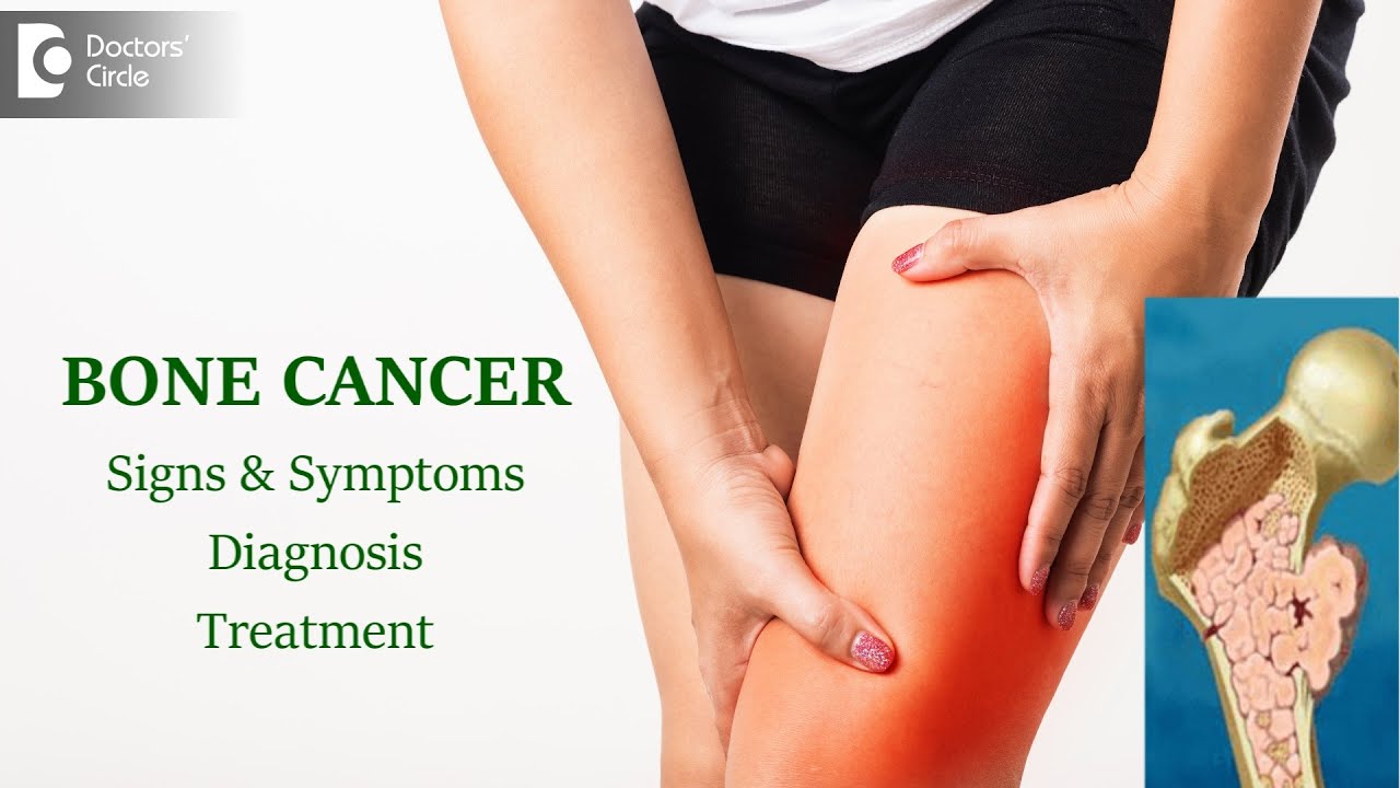 Bone Cancer: Types, Causes, Symptoms, Diagnosis | Bone Marrow-Dr. Mangesh P Kamath | Doctors' Circle