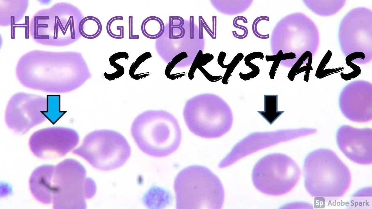 SC Crystals/Cells in Hemoglobin SC Disease (combo of Sickle Cell Anemia Hemoglobin S & Hemoglobin C)