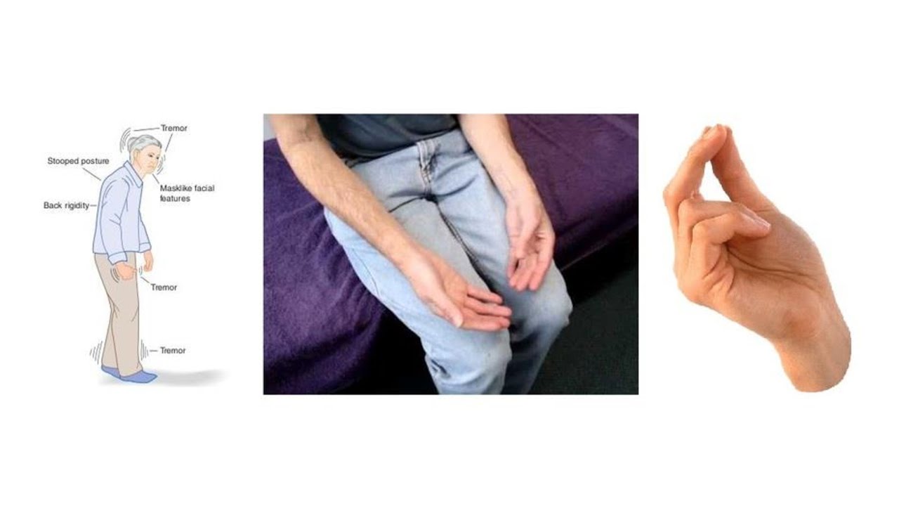 PATTERN DIFFERENTIATION FOR TREMOR & SPASTICITY OF LIMBS