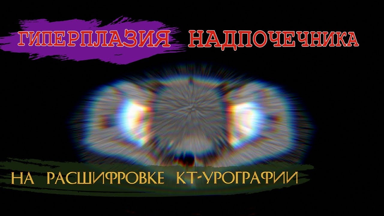 КАМНИ В ПОЧКАХ, гиперплазия надпочечника и МОЧЕКАМЕННАЯ БОЛЕЗНЬ на РАСШИФРОВКЕ КТ урографии 2 мнение