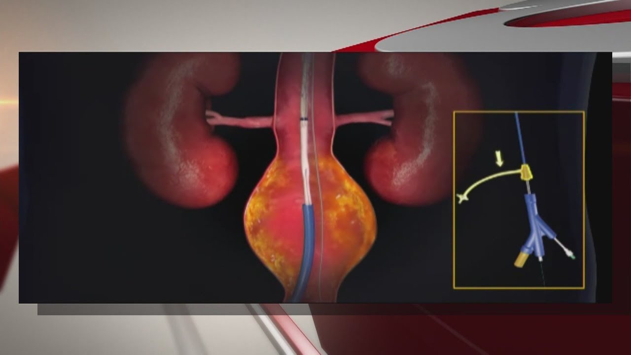 Preventing deadly stomach aneurysms
