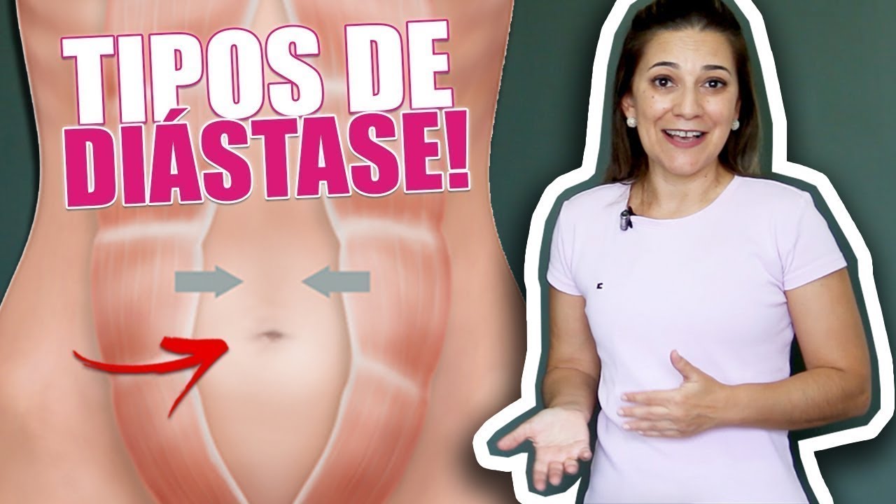 Tipos de Barriga e Diástase, Descubra se Você Tem e a Sua Localização