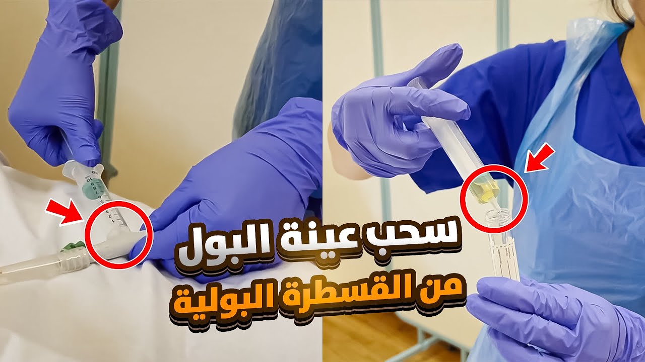 اساسيات التمريض | (22) سحب عينة بول من القسطرة البولية - Urine Sample Collection from Catheter