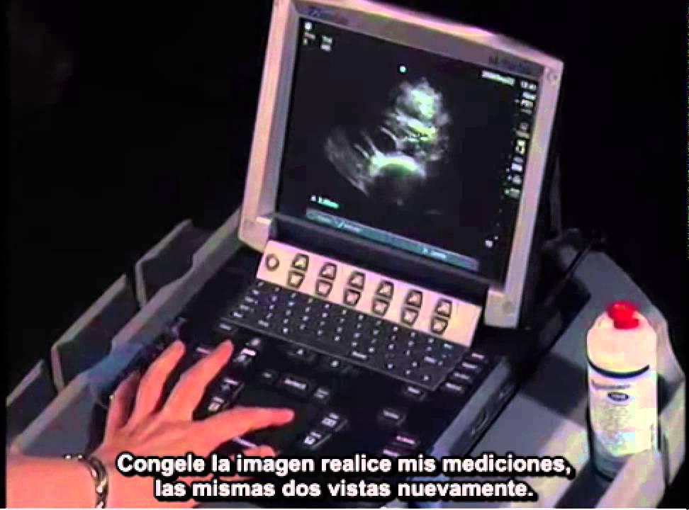 Procedimiento para realizar un estudio ecográfico de la aorta abdominal