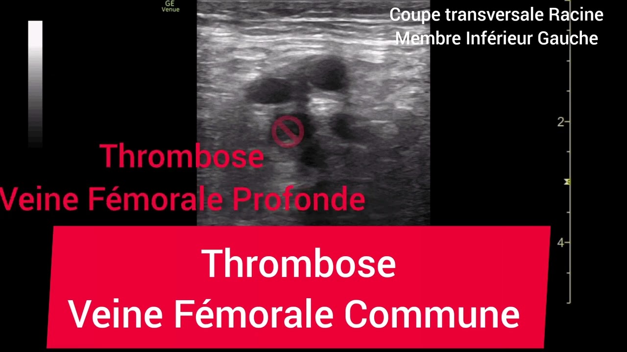 Thrombose Veineuse Profonde Veine F&eacute;morale Commune &Eacute;chographie (Deep Vein Thrombosis)