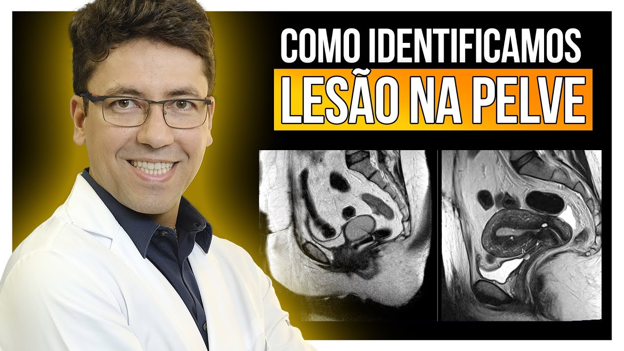 Utilizando MARCOS ANATÔMICOS para identificar lesão no RM de PELVE