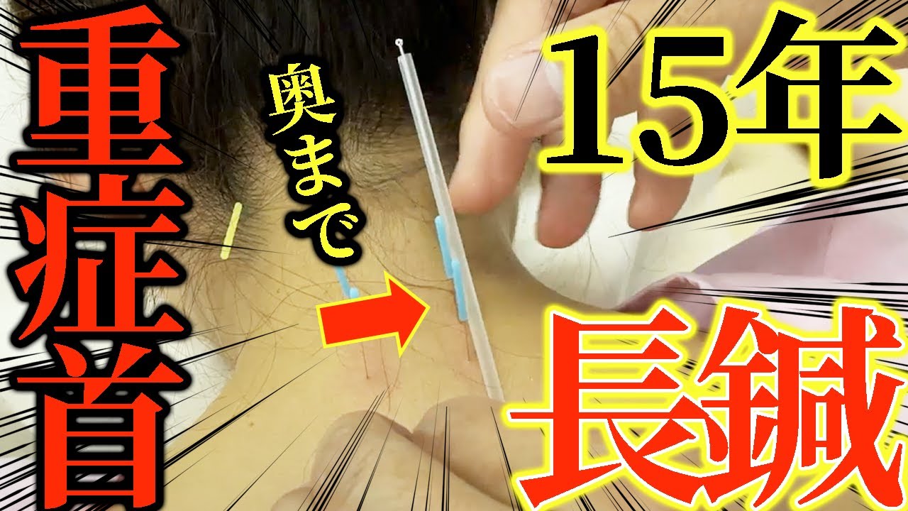 【鍼治療】え？小学生から15年以上悩むガチガチの首　長い鍼でガッツリ治療です　首を秒で治す自宅でできる方法も教えます　【鍼灸院　ブレア銀座　ブレア元町】