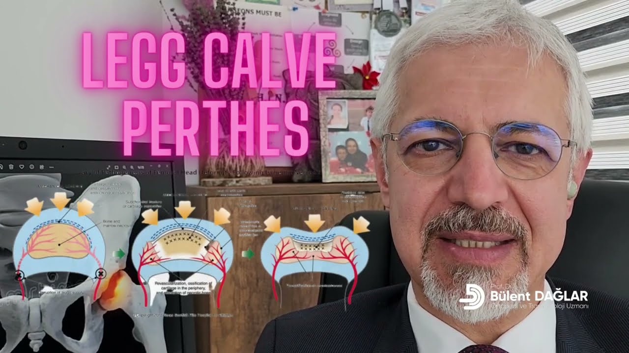 Legg calve perthes hastalığı. Legg Calve Perthes Disease. &Ccedil;ocuk ortopedisi