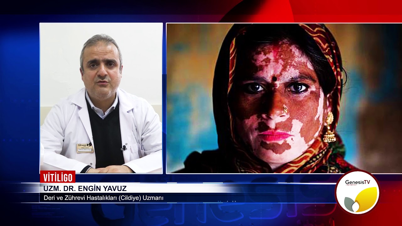Vitiligo Hastalığı - Cildiye Uzmanı Uzm. Dr. Engin Yavuz