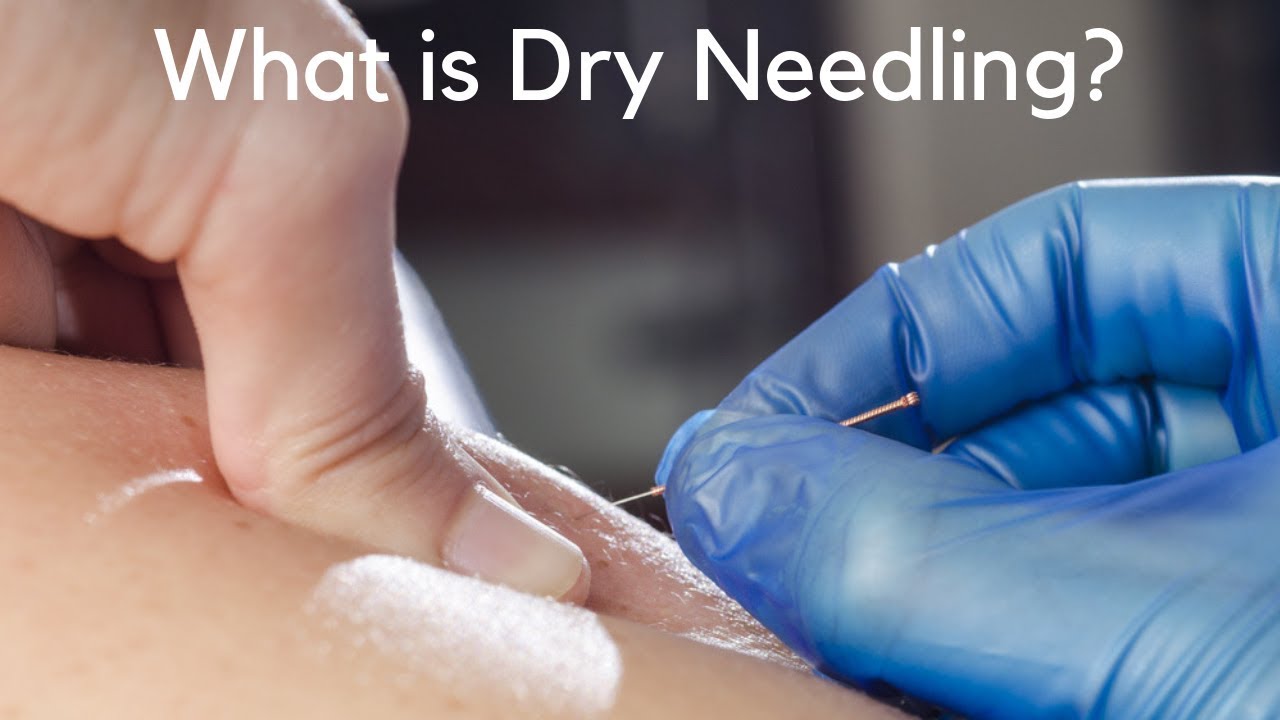 What is Dry Needling? Chiropractor in Burke, VA