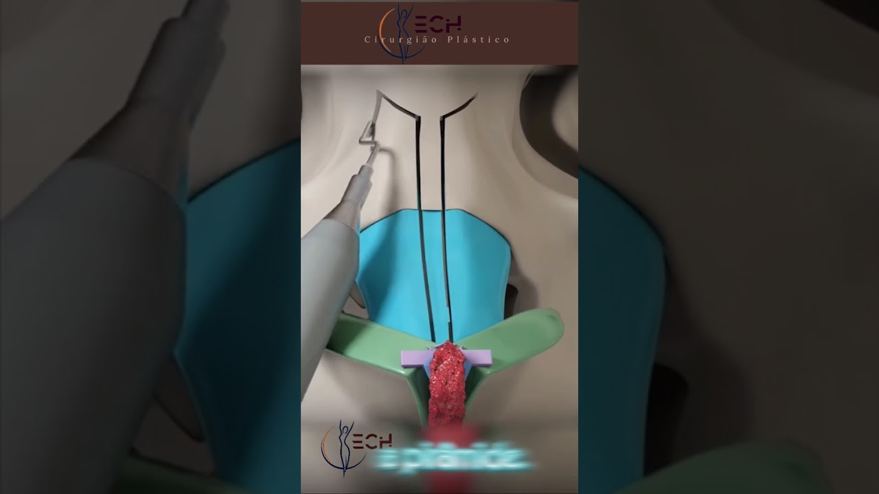Rinoplastia em Nariz negroide