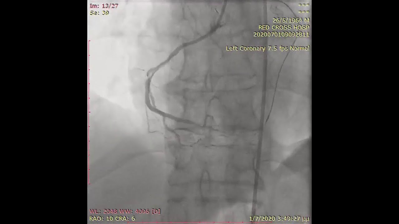 RCA CTO during total revascularization