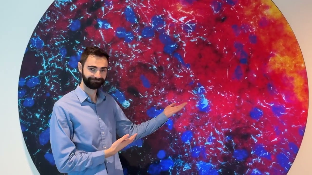 Andrew Pickering  on Nanoparticles Targeting Brain Cancer