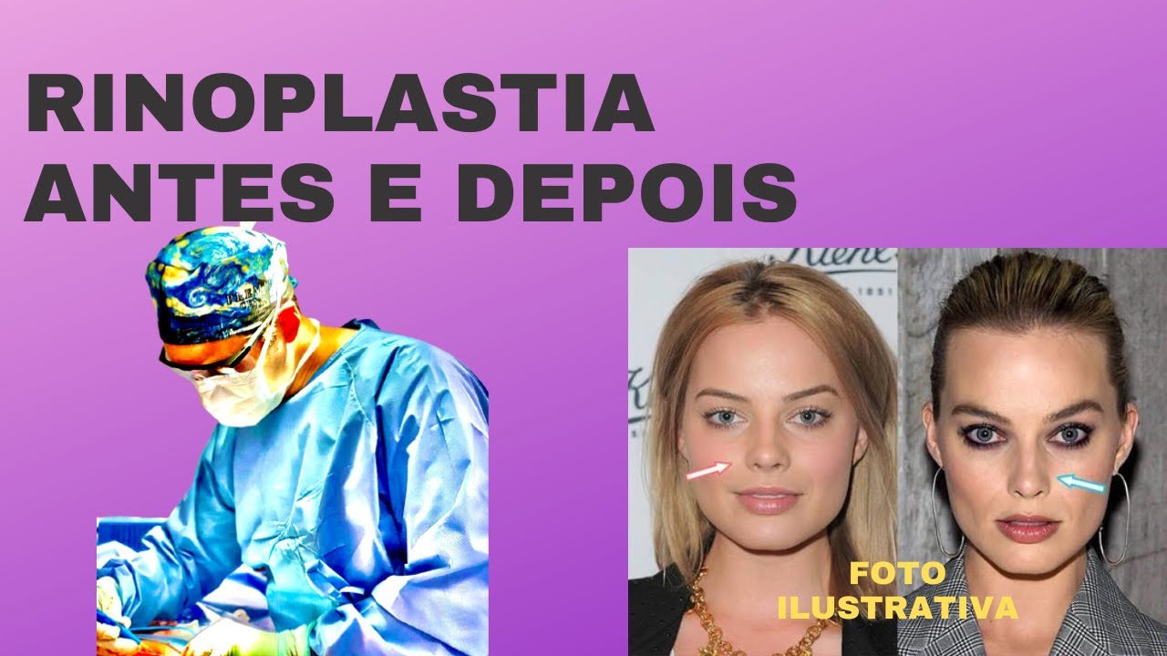 Rinoplastia antes e depois (pre e pos)