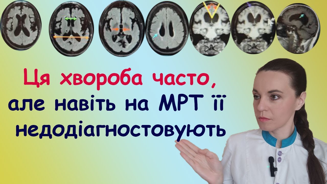 Внутрішня гідроцефалія у дорослих (високий черепний тиск симптоми). Нормотензивна гідроцефалія .