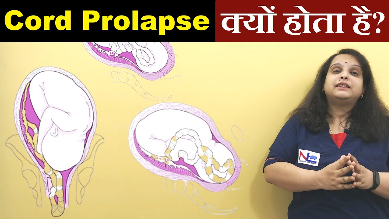 Cord Prolapse in Hindi | Definition, Risk factors, Diagnosis | Nursing Lecture
