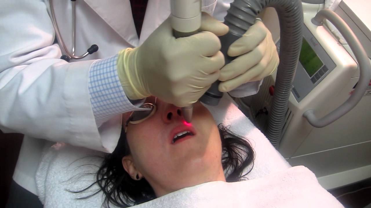 Micro Laser Peel- Fullerton-Irvine-Anaheim-Newport Beach-Long Beach-Cerritos-Pasadena-Corona
