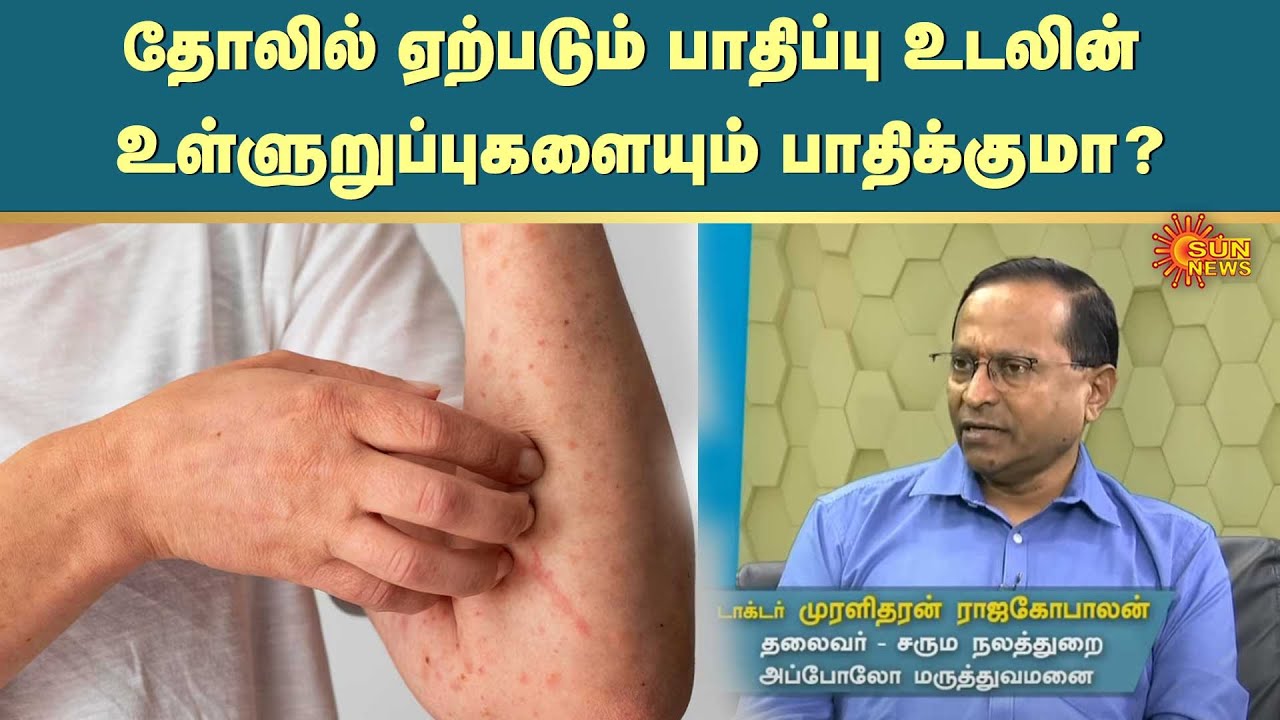 Skin Allergies | தோலில் ஏற்படும் பாதிப்பு உடலின் உள்ளுறுப்புகளையும் பாதிக்குமா? | Sun News