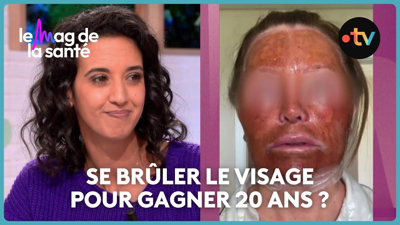 Peeling profond : une technique sans danger pour effacer les rides ?