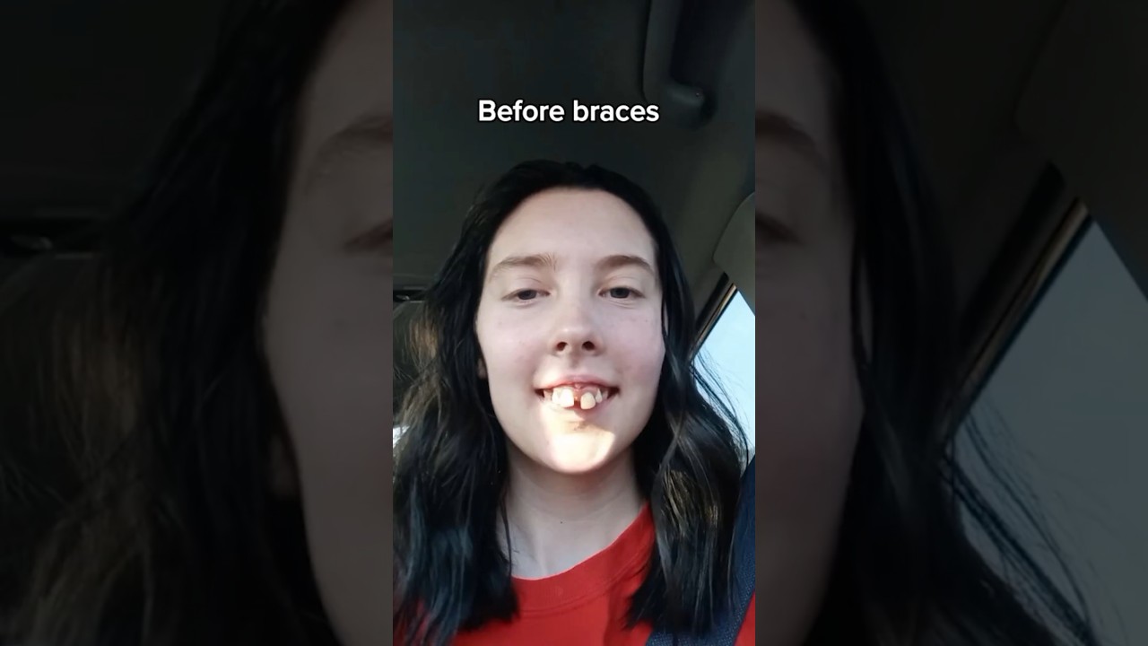 Crazy dental transformation with braces