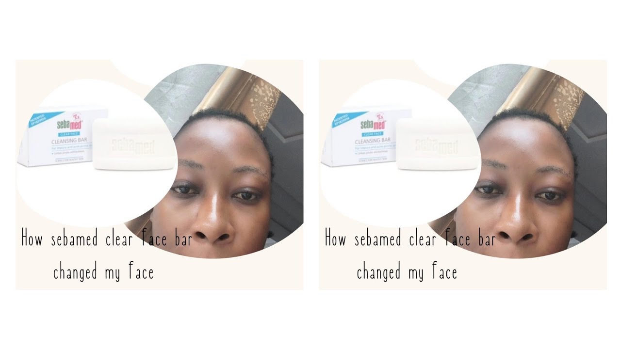 How sebamed clear face helped my face
