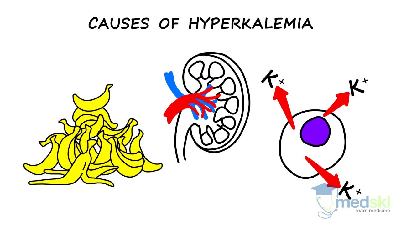 Internal Medicine – Hyperkalemia: By Ben Schelew M.D.