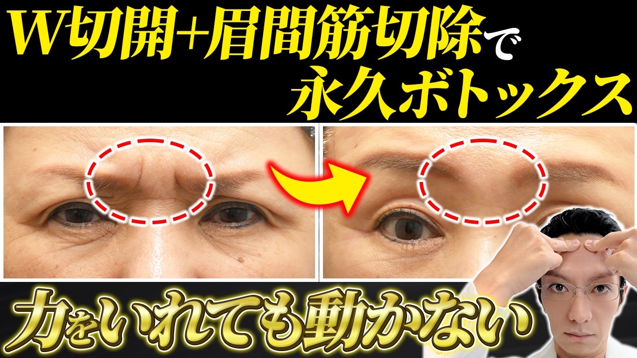 【フルフェイスに匹敵！？】前額リフトの若返り効果と特徴を解説